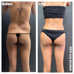 שאיבת שומן לפני אחרי