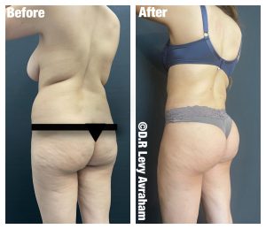 שאיבת שומן לפני אחרי