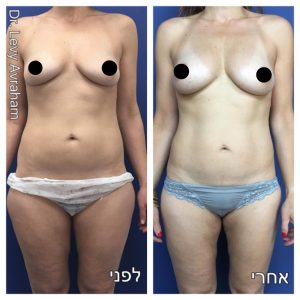 שאיבת שומן לפני אחרי