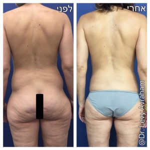 שאיבת שומן לפני אחרי