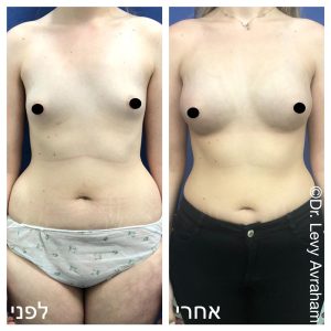 שאיבת שומן לפני אחרי