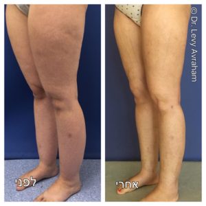 שאיבת שומן לפני אחרי