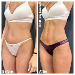 שאיבת שומן לפני ואחרי