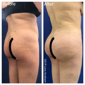 שאיבת שומן לפני ואחרי