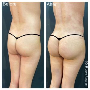 שאיבת שומן לפני ואחרי