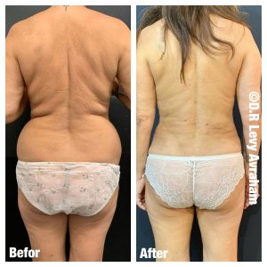 שאיבת שומן לפני אחרי