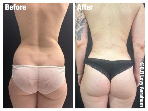 שאיבת שומן לפני אחרי