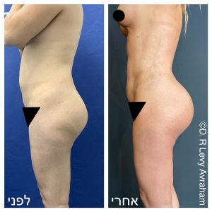 ניתוח הגדלת ישבן