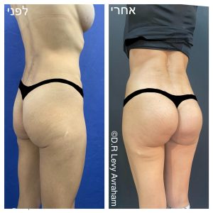 ניתוח לעיצוב ישבן