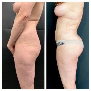 עיצוב הישבן