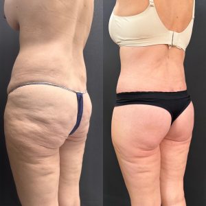 הרמת ישבן ועיצוב