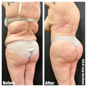 ניתוח הרמת ישבן