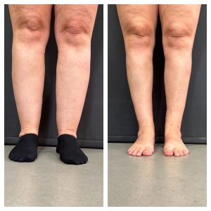 שאיבת שומן ברגליים לפני אחרי