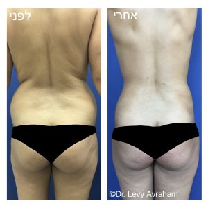 שאיבת שומן לפני אחרי