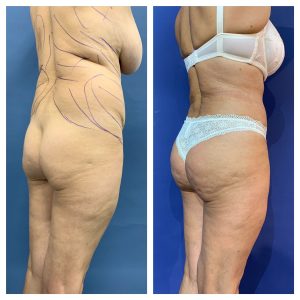 שאיבת שומן לפני אחרי