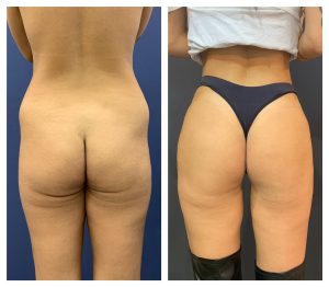 שאיבת שומן לפני אחרי