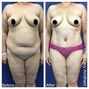 מתיחת בטן תמונה לפני אחרי