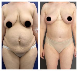 מתיחת בטן לפני ואחרי