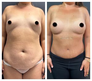 מתיחת בטן לפני אחרי