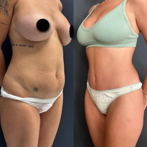 מתיחת בטן לפני אחרי