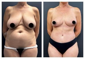 מתיחת בטן לפני אחרי