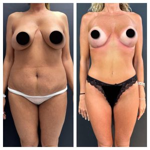 מתיחת בטן לפני אחרי