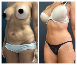 מתיחת בטן לפני אחרי