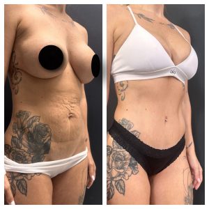 מתיחת בטן לפני אחרי