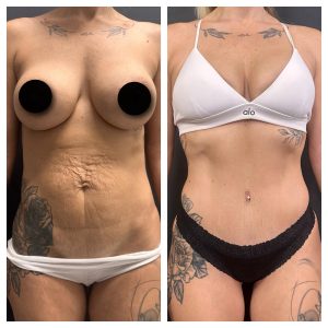 מתיחת בטן לפני אחרי