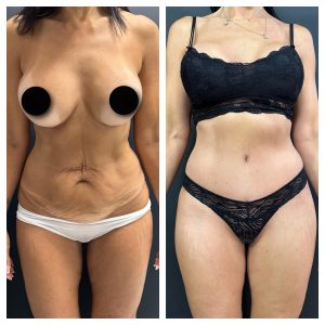 מתיחת בטן לפני אחרי