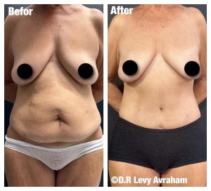 ניתוח מתיחת בטן לפני אחרי