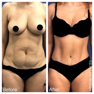 ניתוח מתיחת בטן תמונה ראשית