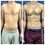 ניתוח ריבועים בבטן לגברים