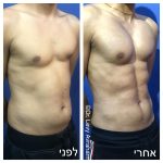 ניתוח קוביות בבטן לגברים