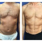 ניתוח לריבועים בבטן