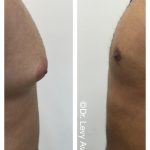 גניקומסטיה