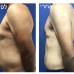 גניקומסטיה לפני ואחרי