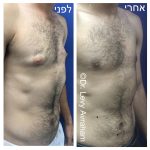 גניקומסטיה לפני ואחרי