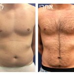 גניקומסטיה לפני ואחרי