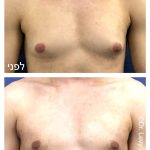 גניקומסטיה תמונה לפני ואחרי