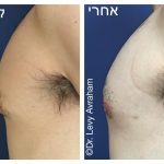 גניקומסטיה תמונה לפני ואחרי