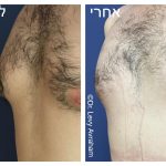 ניתוח גניקומסטיה תמונה לפני ואחרי