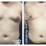 ניתוח גניקומסטיה