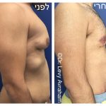 ניתוח גניקומסטיה