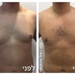 ניתוח גניקומסטיה