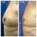 ניתוח גניקומסטיה