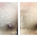 ניתוח גניקומסטיה