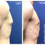 ניתוח גניקומסטיה ד"ר לוי אברהם