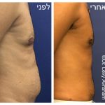 ניתוח גניקומסטיה ד"ר לוי אברהם