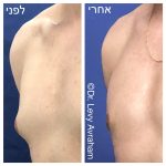 ניתוח גניקומסטיה ד"ר לוי אברהם
